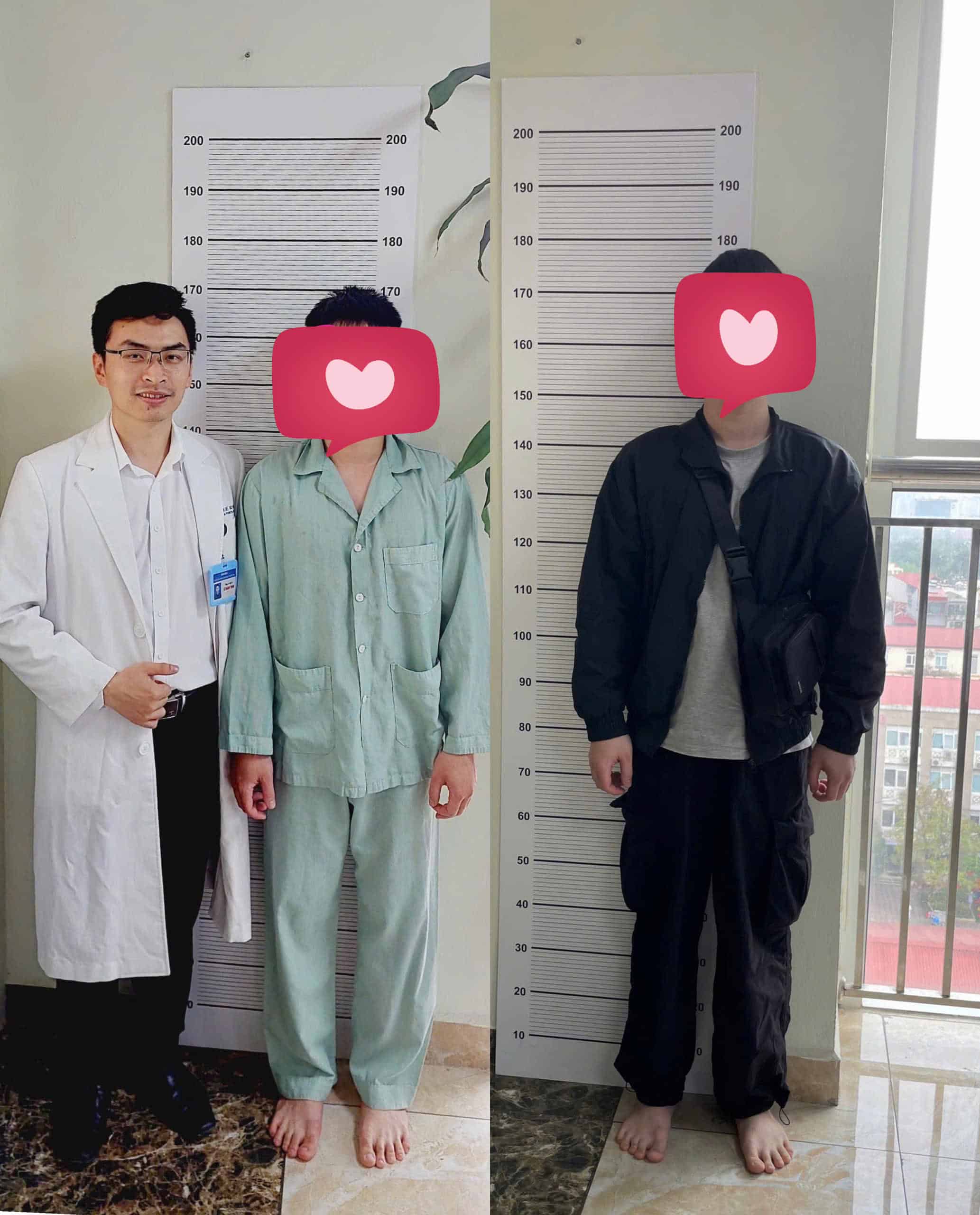 Hình ảnh trước sau phẫu thuật kéo dài xương đùi 24 tuổi