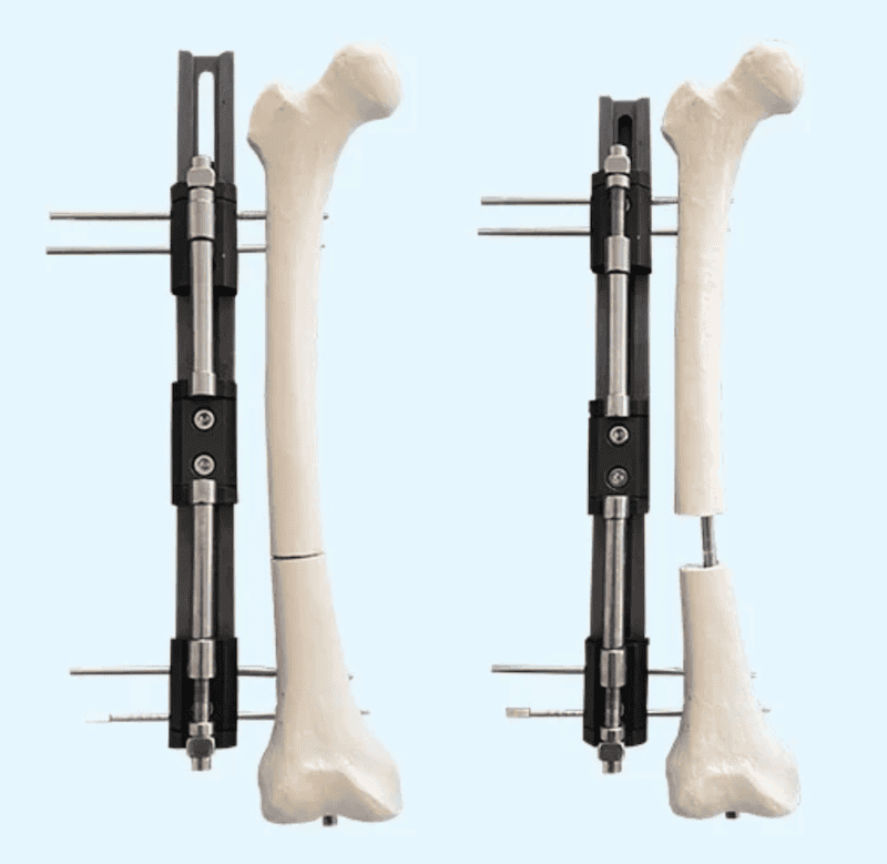 kéo dài xương đùi