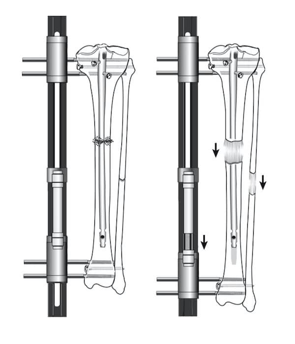 kéo dài chân - kéo dài cẳng chân