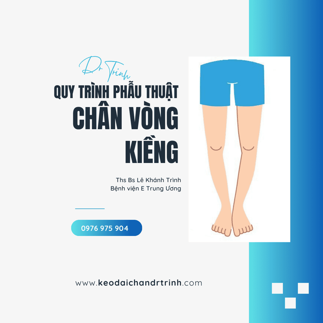 quy trình phẫu thuật chân vòng kiềng