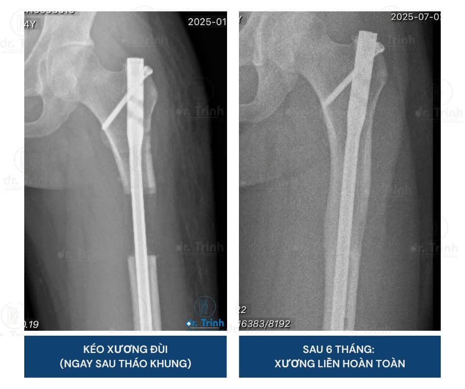 X-quang kết quả kéo dài chân tăng 6cm