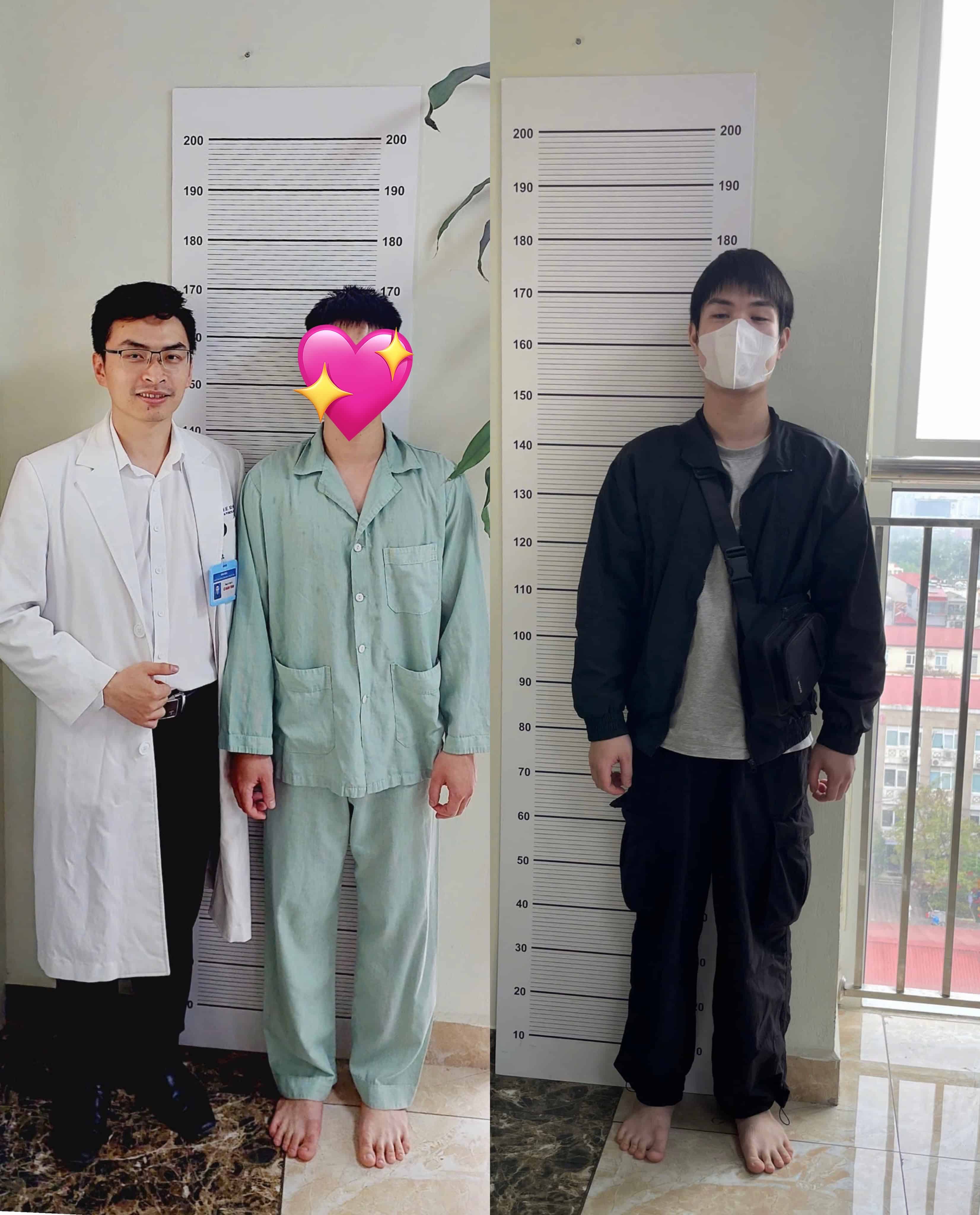 Hình ảnh trước sau phẫu thuật kéo dài xương đùi 24 tuổi