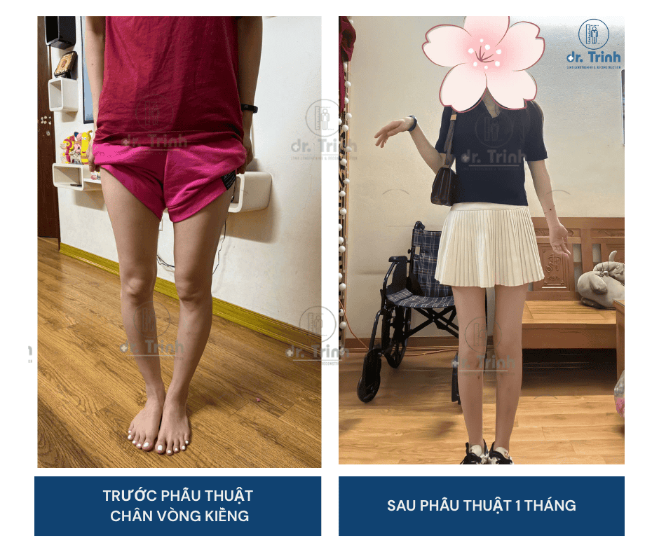 Ảnh trước sau phẫu thuật chân vòng kiềng bệnh nhân nữ 36 tuổi tại Hà Nội