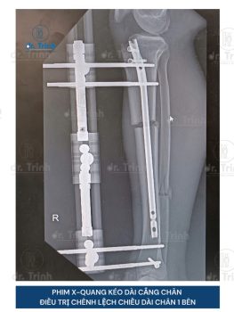 Quá trình Kéo dài xương đùi