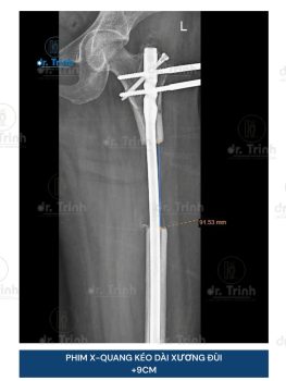 Kết quả kéo dài xương đùi