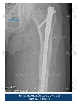 Kết quả kéo dài xương đùi
