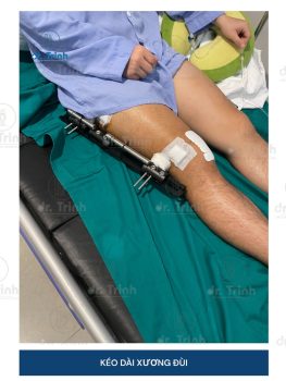Chi phí kéo dài xương đùi