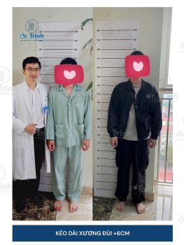 Kết quả kéo dài xương đùi