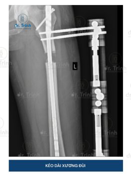 bệnh viện kéo dài chân